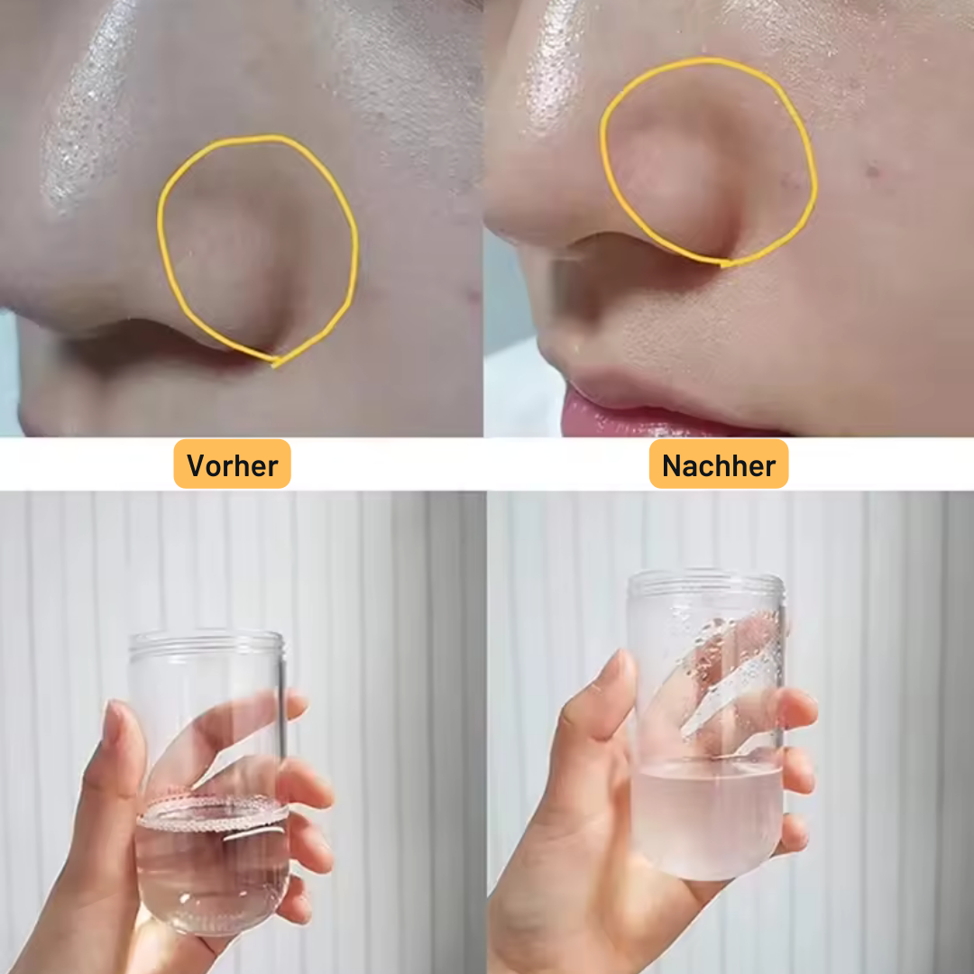Mitessersauger Aqua Peeling Gerät – Hydra-Dermabrasion mit Sauerstoffzufuhr – Professionelle Reinigung für zuhause