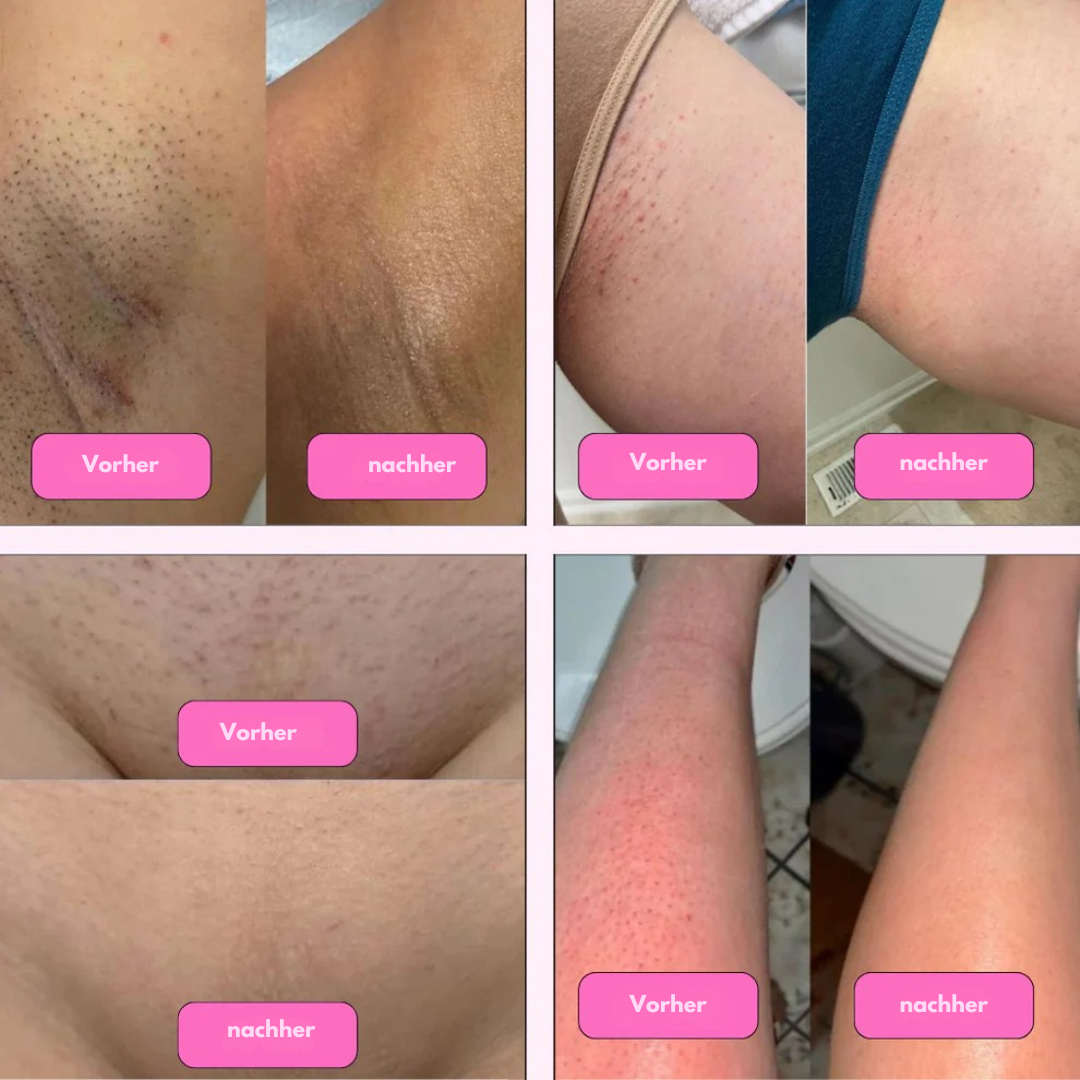 IPL Haarentfernung Gerät – Laser-Depilator für zuhause – Dauerhafte & schmerzfreie Haarentfernung für glatte Haut - Effektive IPL-Behandlung für Beine, Achseln, Arme & Intimbereich