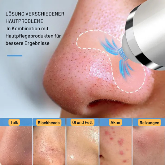 Mitessersauger Aqua Peeling Gerät – Hydra-Dermabrasion mit Sauerstoffzufuhr – Professionelle Reinigung für zuhause